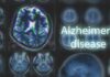 Alzheimer’s Test Uncovers Hidden CTE Clues Brain MRI scans with highlighted section and text overlay